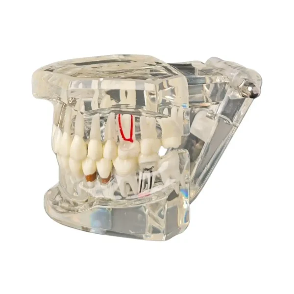 Evodent All in One with Three Implants