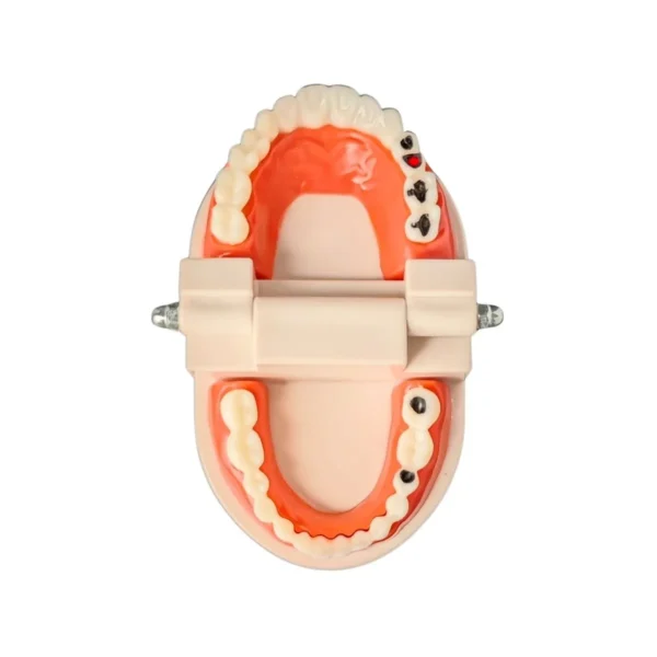 Evodent Model With Caries