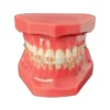 Evodent Orthodontic Model With Ceramic Bracket, Pink