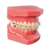 Evodent Orthodontic Model With Ceramic Bracket, Pink