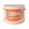 Evodent Orthodontic Model With Metal Bracket