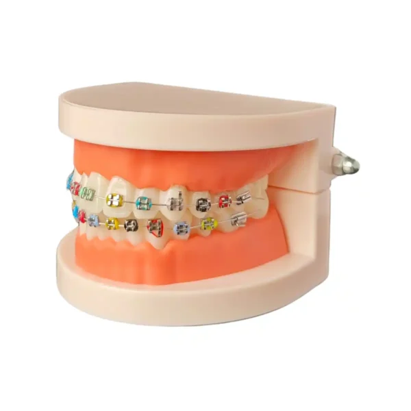 Evodent Orthodontic Model with Metal Bracket