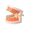 Evodent Orthodontic Model With Metal Bracket