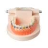 Evodent Orthodontic Model With Metal Bracket