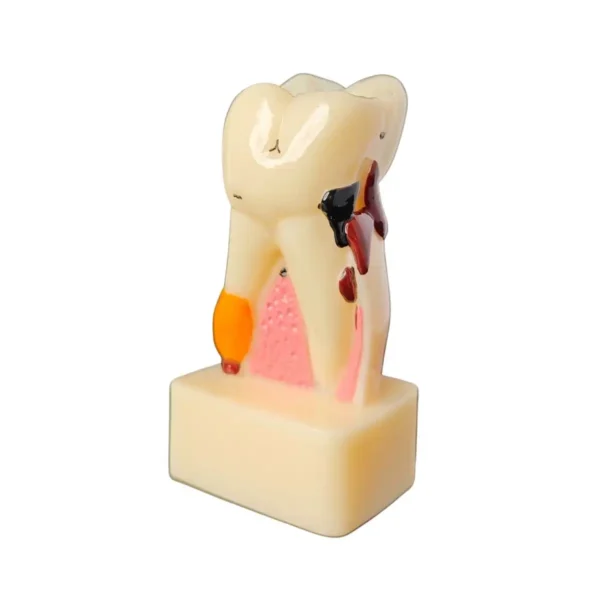 Evodent Periodontal Disease Model with Tooth Cross Section