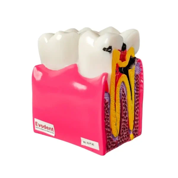 Evodent Tooth Decay Cross Section Comparison