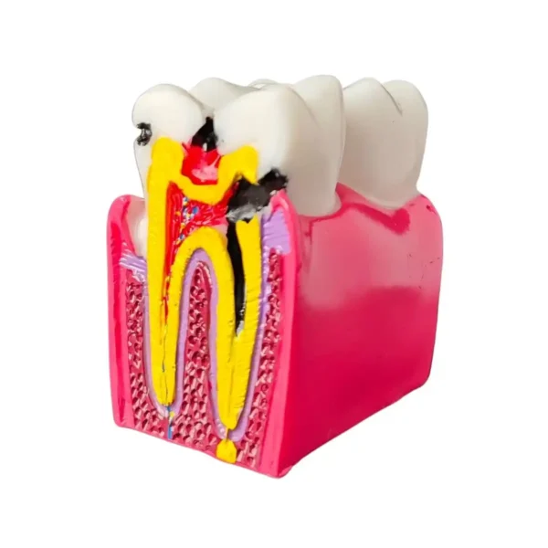 Evodent Tooth Decay Cross Section Comparison