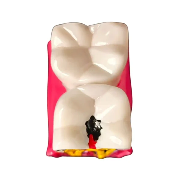 Evodent Tooth Decay Cross Section Comparison