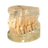 Evodent Orthodontic Model Class I Malocclusion Clear