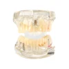 Evodent All In One With Three Implant Fpd