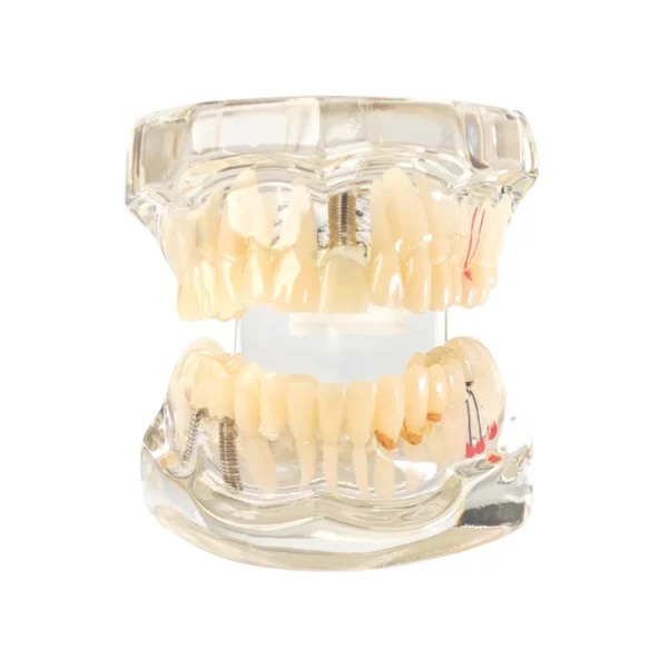 Evodent All in One with Three Implant FPD