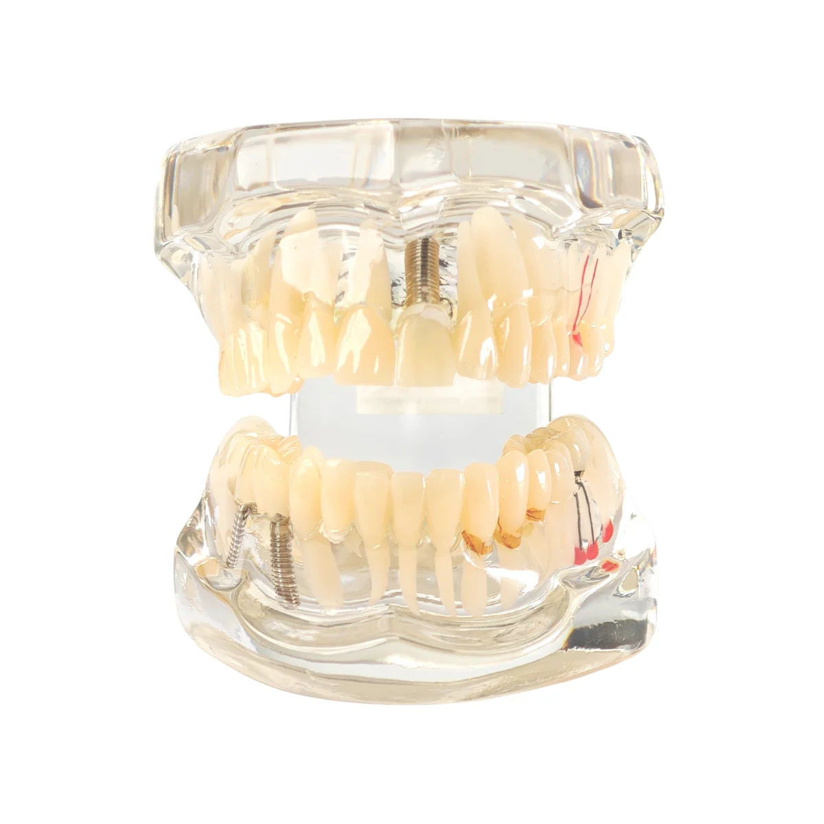 All In One Solution Evodent All In One With Three Implant FPD