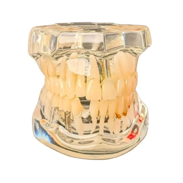 Evodent All in One with Three Implant FPD