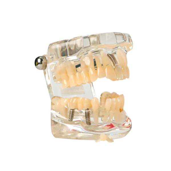 Evodent All in One with Three Implant FPD