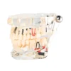 Evodent All In One With Three Implant Fpd