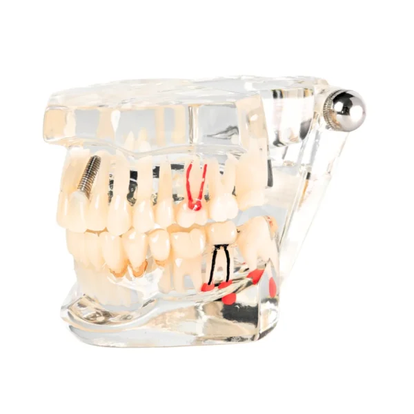 Evodent All in One with Three Implant FPD