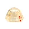 Evodent All In One With Three Implant Fpd