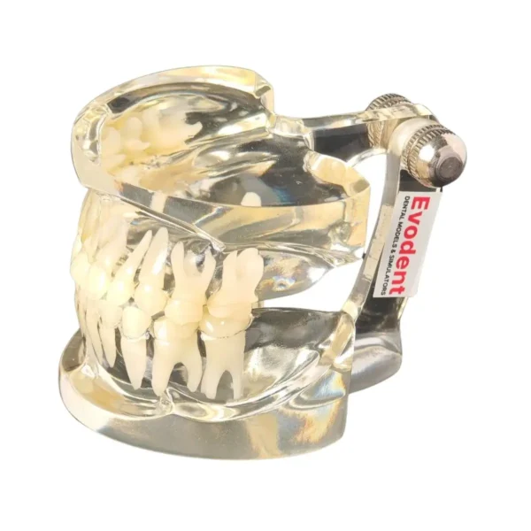 Evodent Orthodontic Model Class I Malocclusion Clear