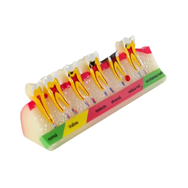 Evodent Dental Caries Progression Model
