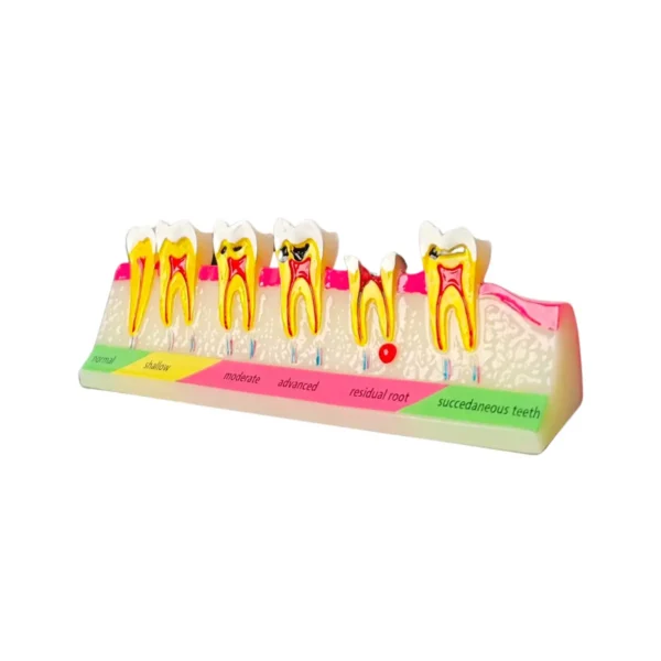 Evodent Dental Caries Progression Model