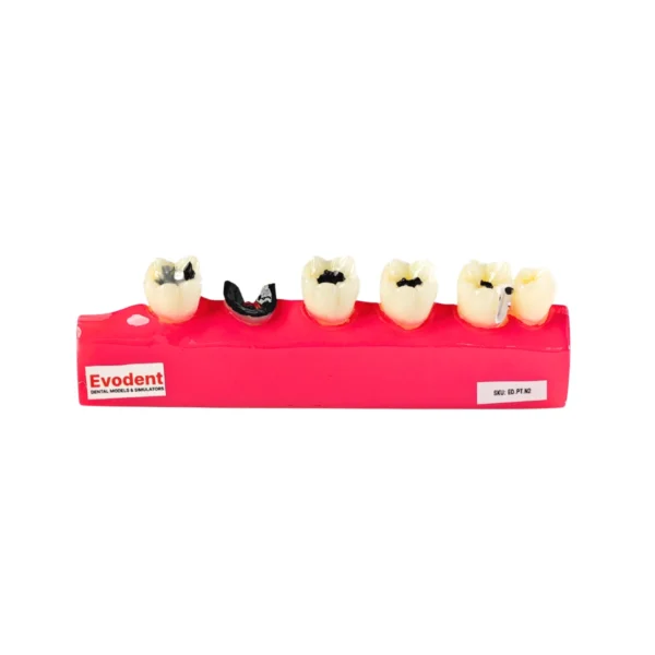 Evodent Dental Caries Progression Model