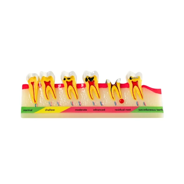 Evodent Dental Caries Progression Model