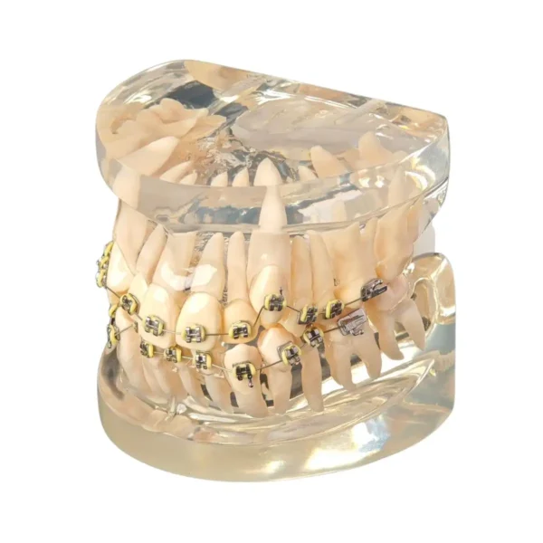 Evodent Malocculation Model with Metal Bracket, Clear