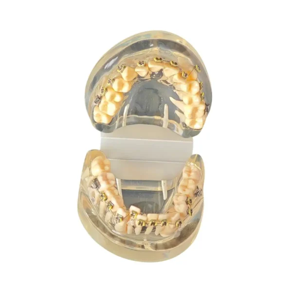 Evodent Malocculation Model with Metal Bracket, Clear