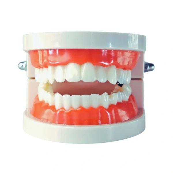 Evodent Model with Caries