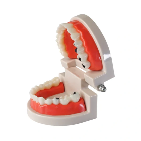 Evodent Model with Caries