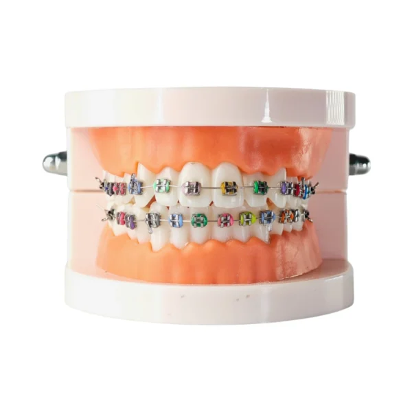 Evodent Orthodontic Model with Metal Bracket