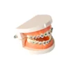 Evodent Orthodontic Model With Metal Bracket 5 Evodent Orthodontic Model With Metal Bracket