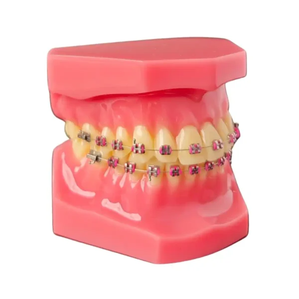 Evodent Orthodontic Model with Metal Bracket, Pink