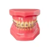 Evodent Orthodontic Model With Metal Bracket, Pink
