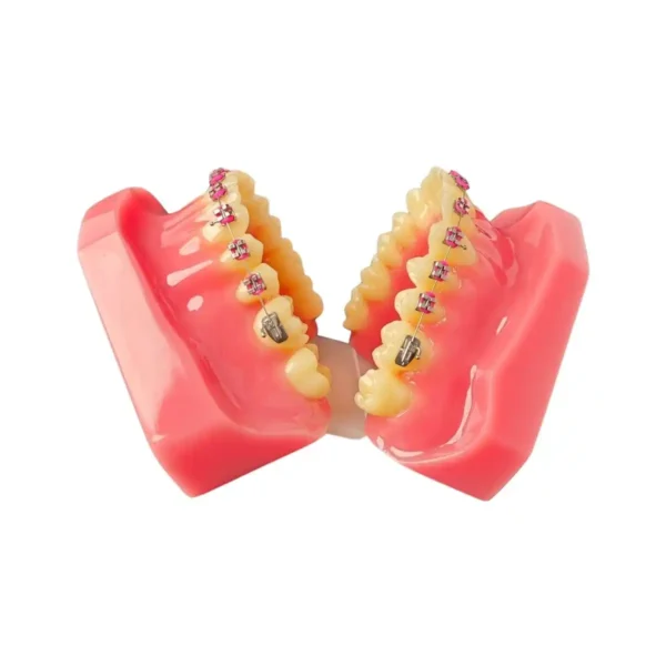 Evodent Orthodontic Model with Metal Bracket, Pink