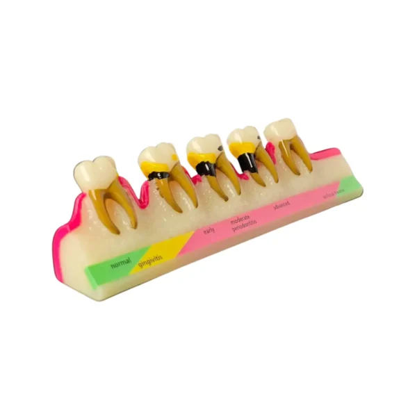 Evodent Periodontal Disease Stages Model