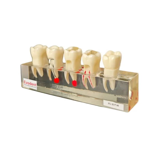 Evodent RCT Treatment Model