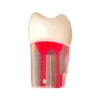 Evodent Root Canal Treatment Practice Model
