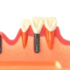 Evodent 4 Step Dental Implant Model