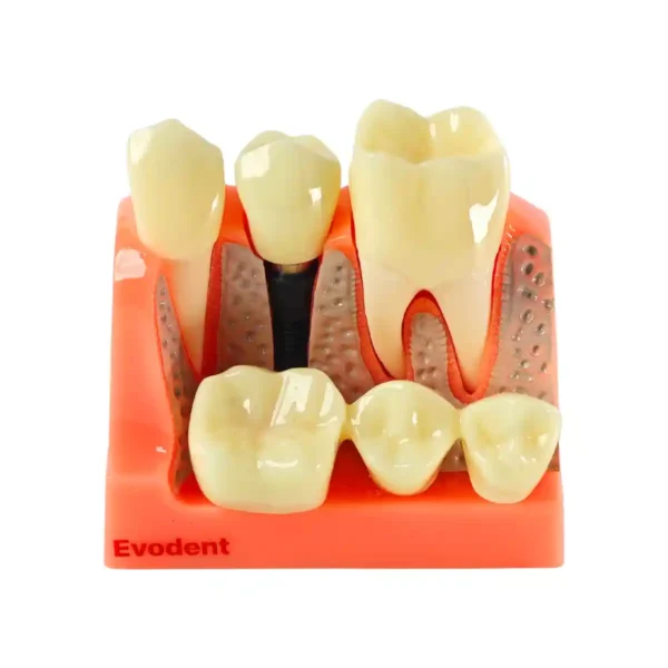 Evodent Dental Implant Demonstration Model for Patient Education