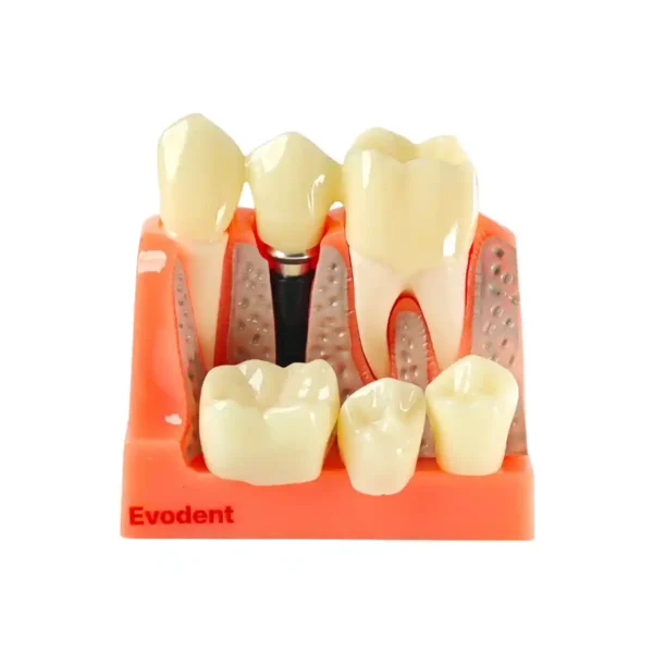 Evodent Dental Implant Demonstration Model for Patient Education