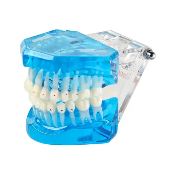 Evodent Orthodontic Model with Ceramic Bracket, Blue