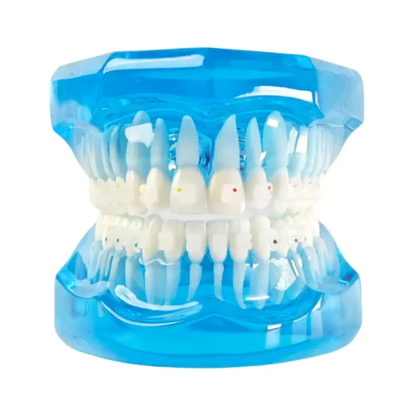 Evodent Orthodontic Model with Ceramic Bracket, Blue
