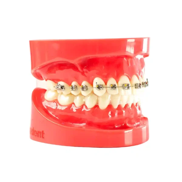 Evodent Orthodontic Braces vs Aligners Comparison Model for Patient Education (Fixed Appliances vs Clear Aligners)