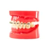 Evodent Orthodontic Braces Vs Aligners Comparison Model For Patient Education (Fixed Appliances Vs Clear Aligners)