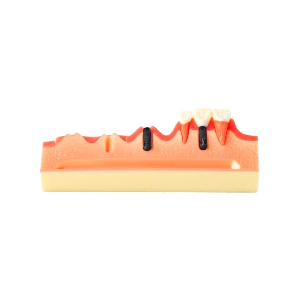 Evodent 4 Step Dental Implant Model