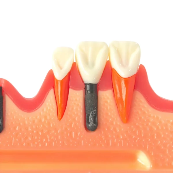 Evodent 4 Step Dental Implant Model