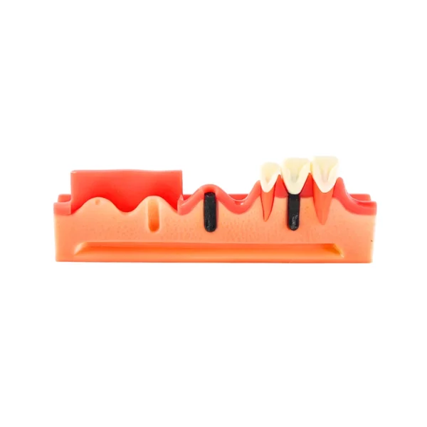 Evodent 4 Step Dental Implant Model