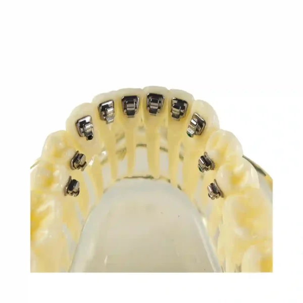 Evodent Orthodontic Model with Lingual Bracket