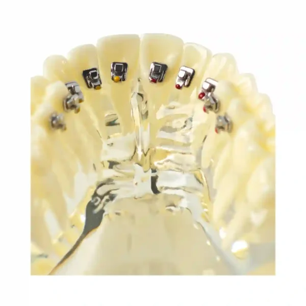 Evodent Orthodontic Model with Lingual Bracket